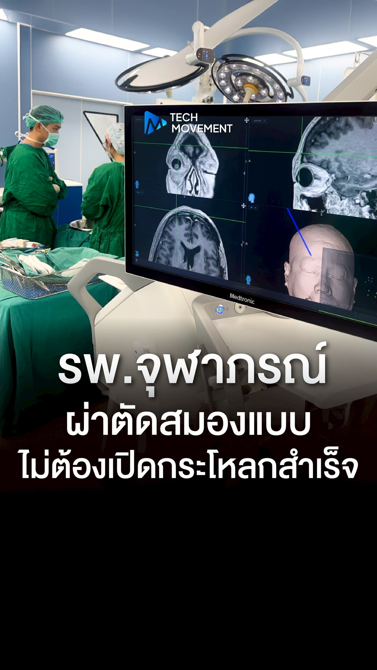 โรงพยาบาลจุฬาภรณ์ ผ่าตัดสมองผ่านคิ้วสำเร็จ