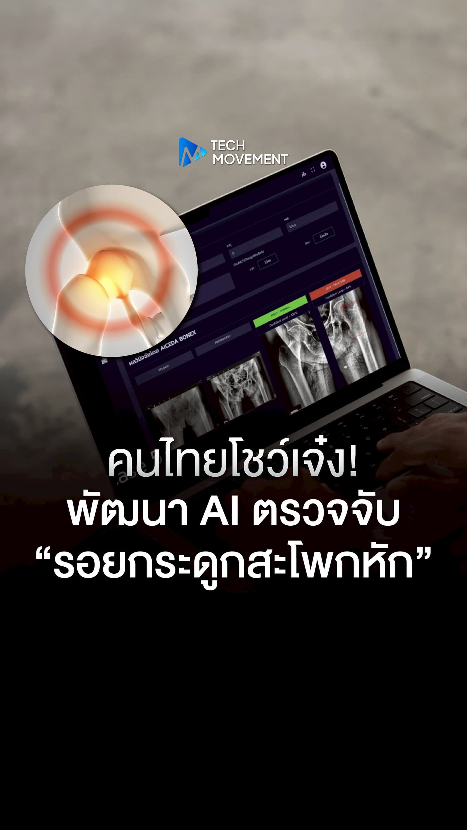 คนไทยโชว์เจ๋ง พัฒนา AI ตรวจจับ รอยกระดูกสะโพกหัก