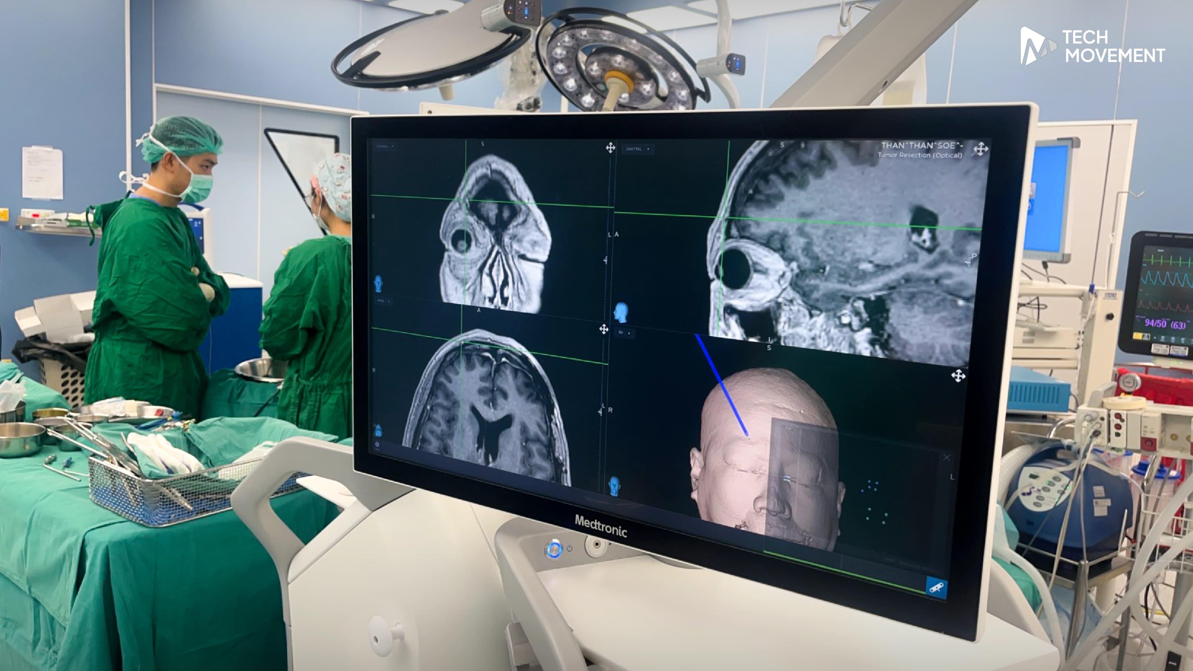 รพ_จุฬาภรณ์_ผ่าตัดสมองแบบไม่ต้องเปิดกะโหลกสำเร็จ